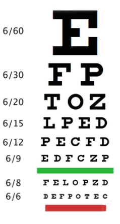 Mature Cataract