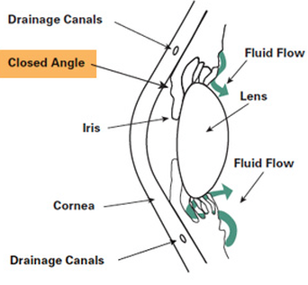 Open Angle