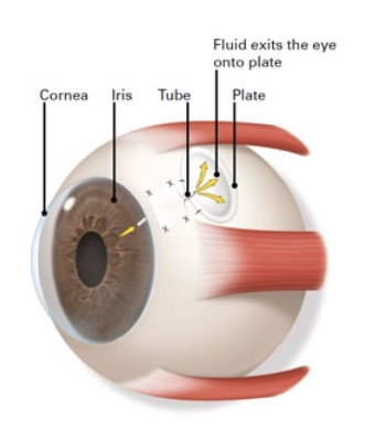 Trabeculectomy