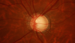 images/Glaucoma Optic Disc