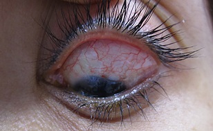 Trabeculectomy