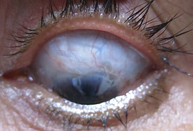 Trabeculectomy